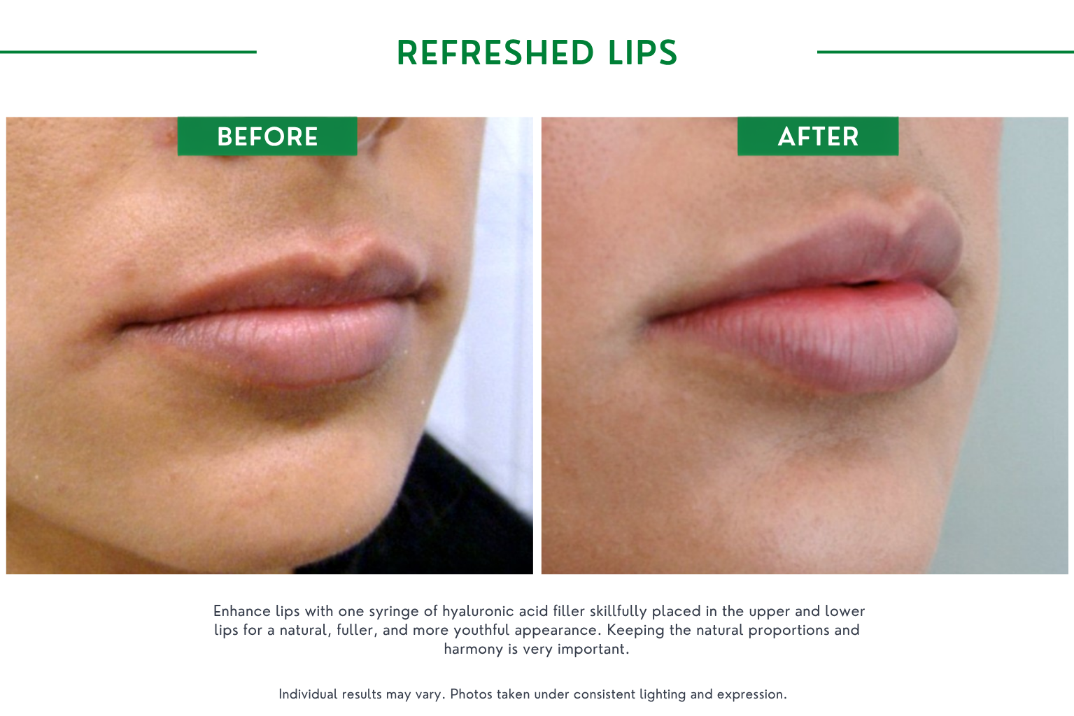 Refresh lips B_A (9)