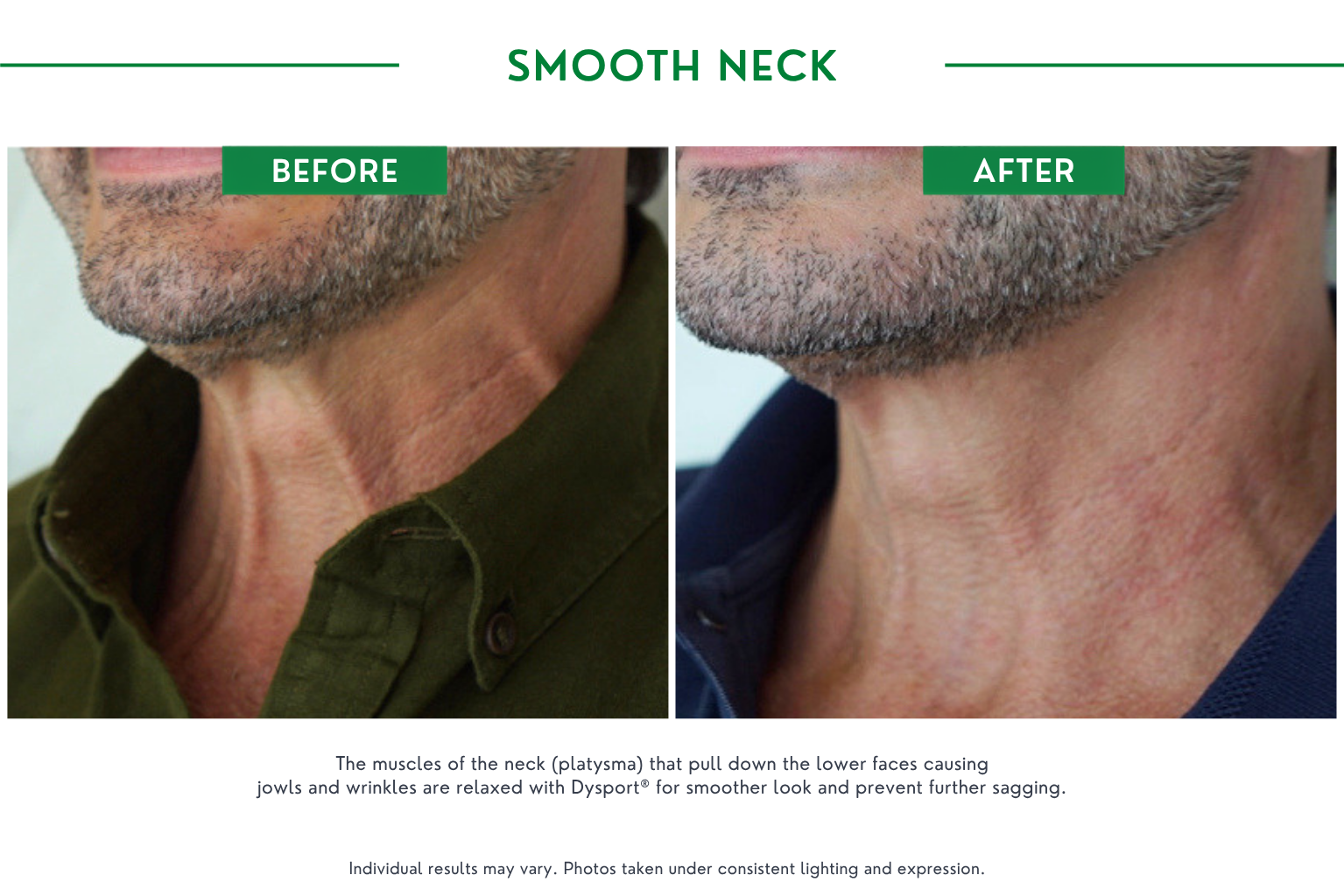 Smooth neck B_A (1)