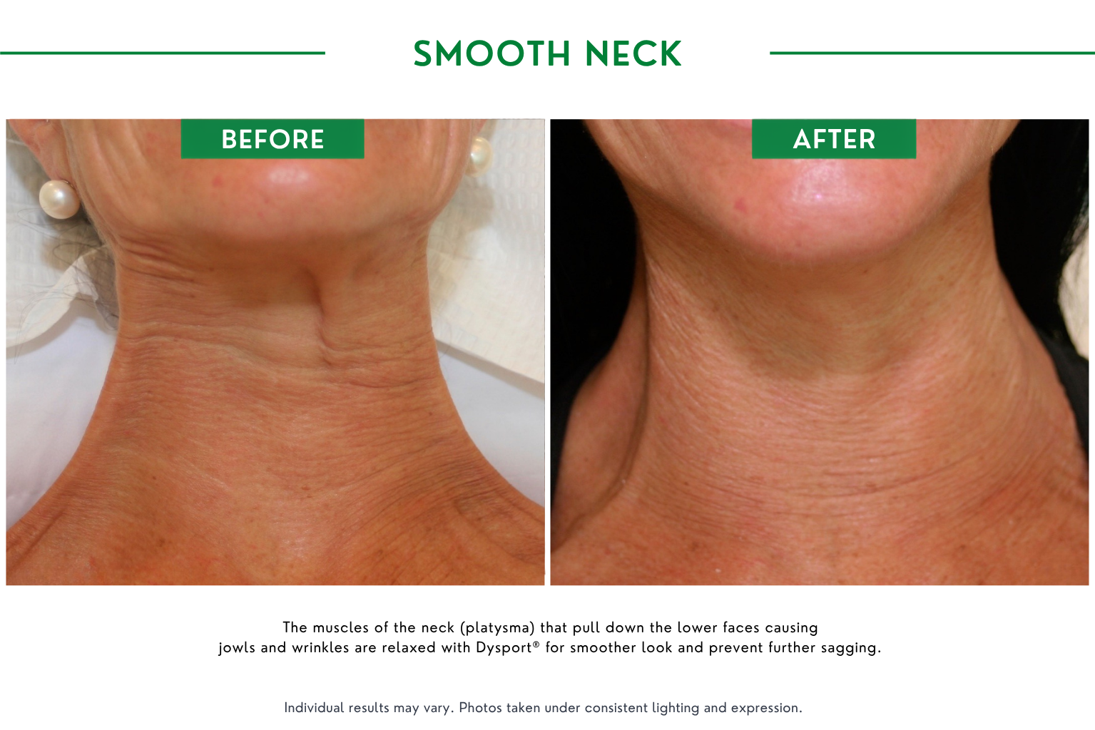 Smooth neck B_A (2)