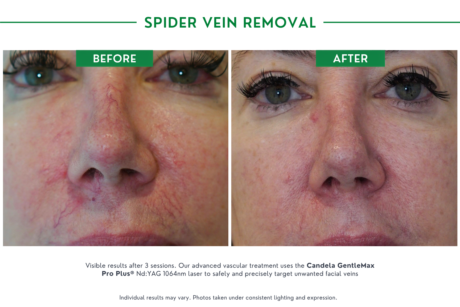 Spider vein B_A (1)