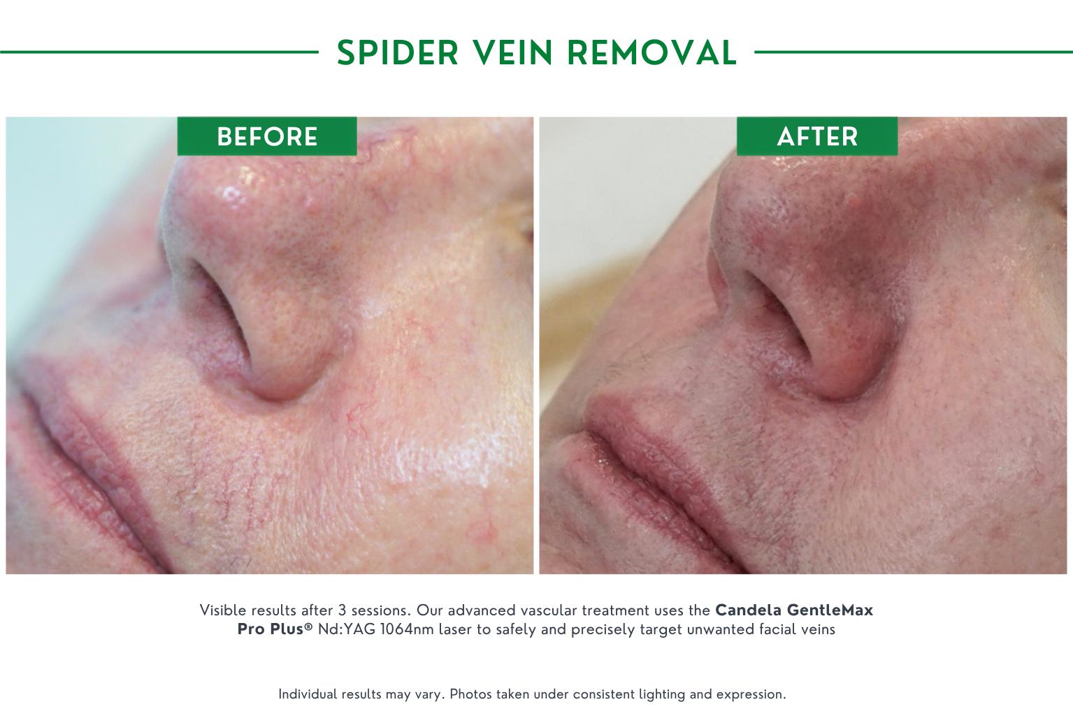 Spider vein B_A (2)