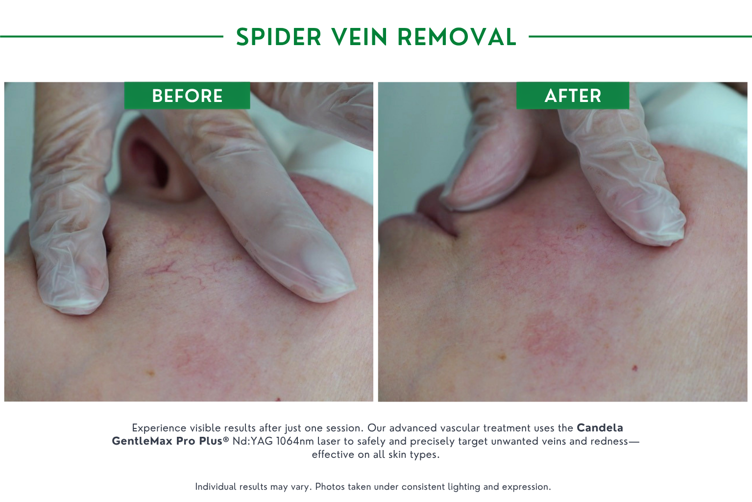 Spider vein B_A (3)