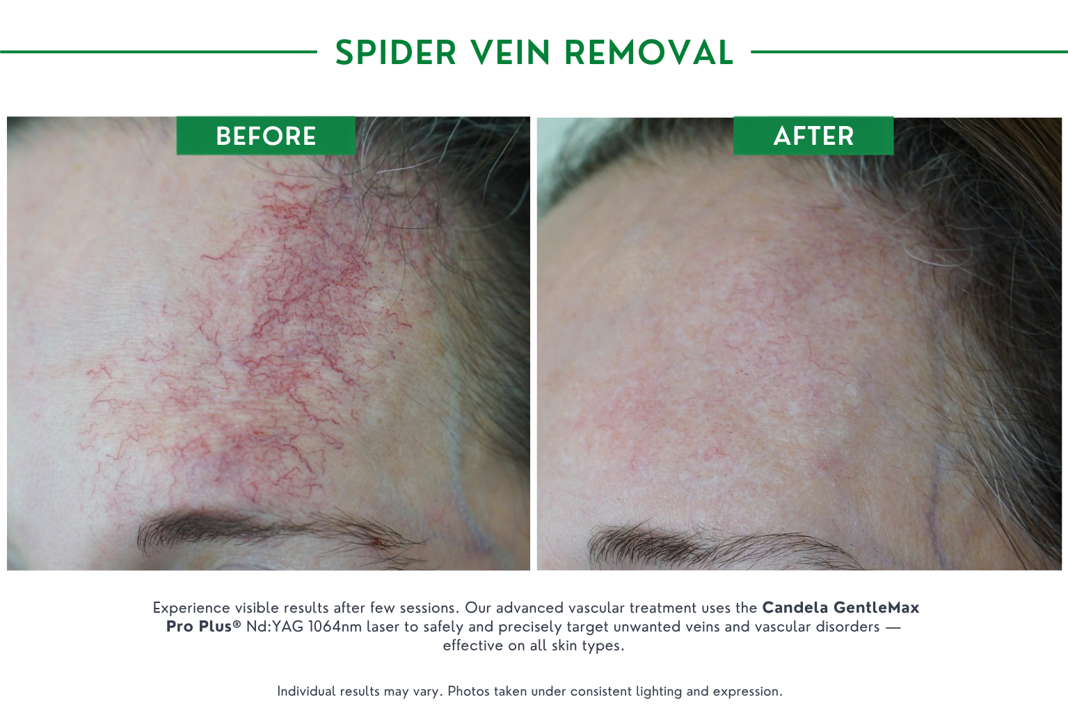 Spider vein B_A (4)