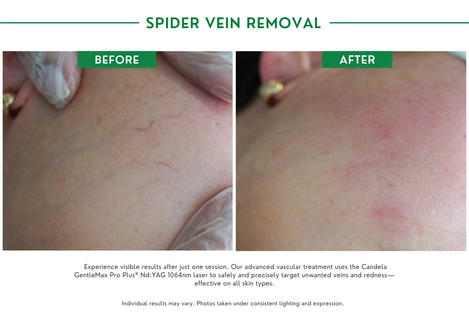Spider vein B_A (5)