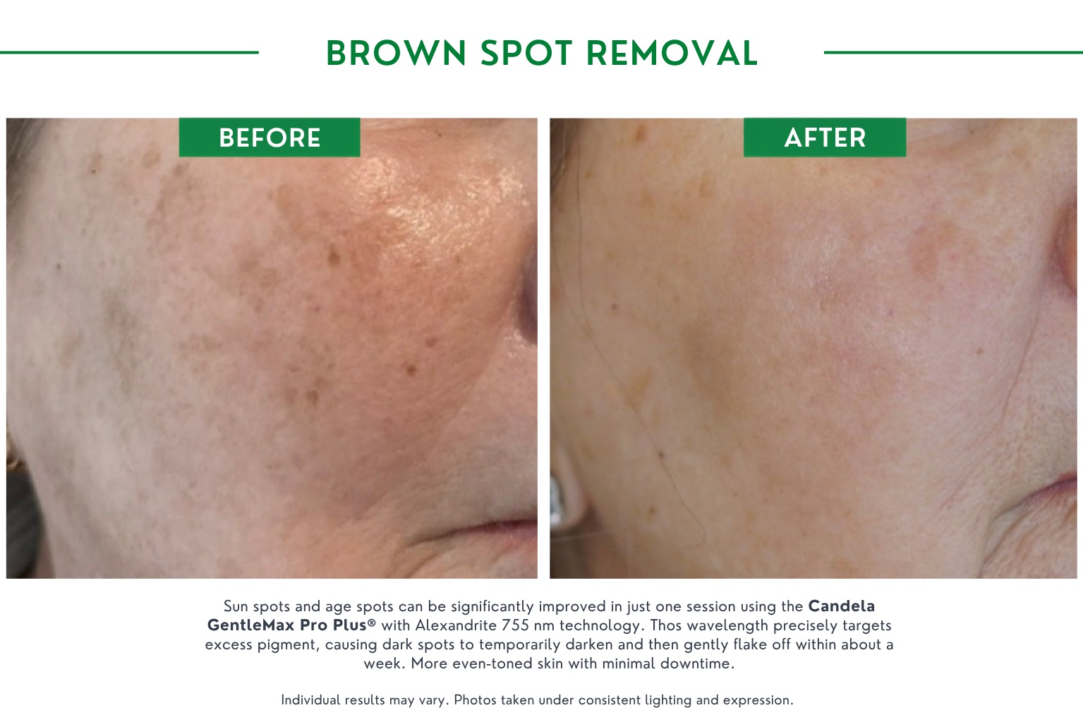 brown spot B_A (1)