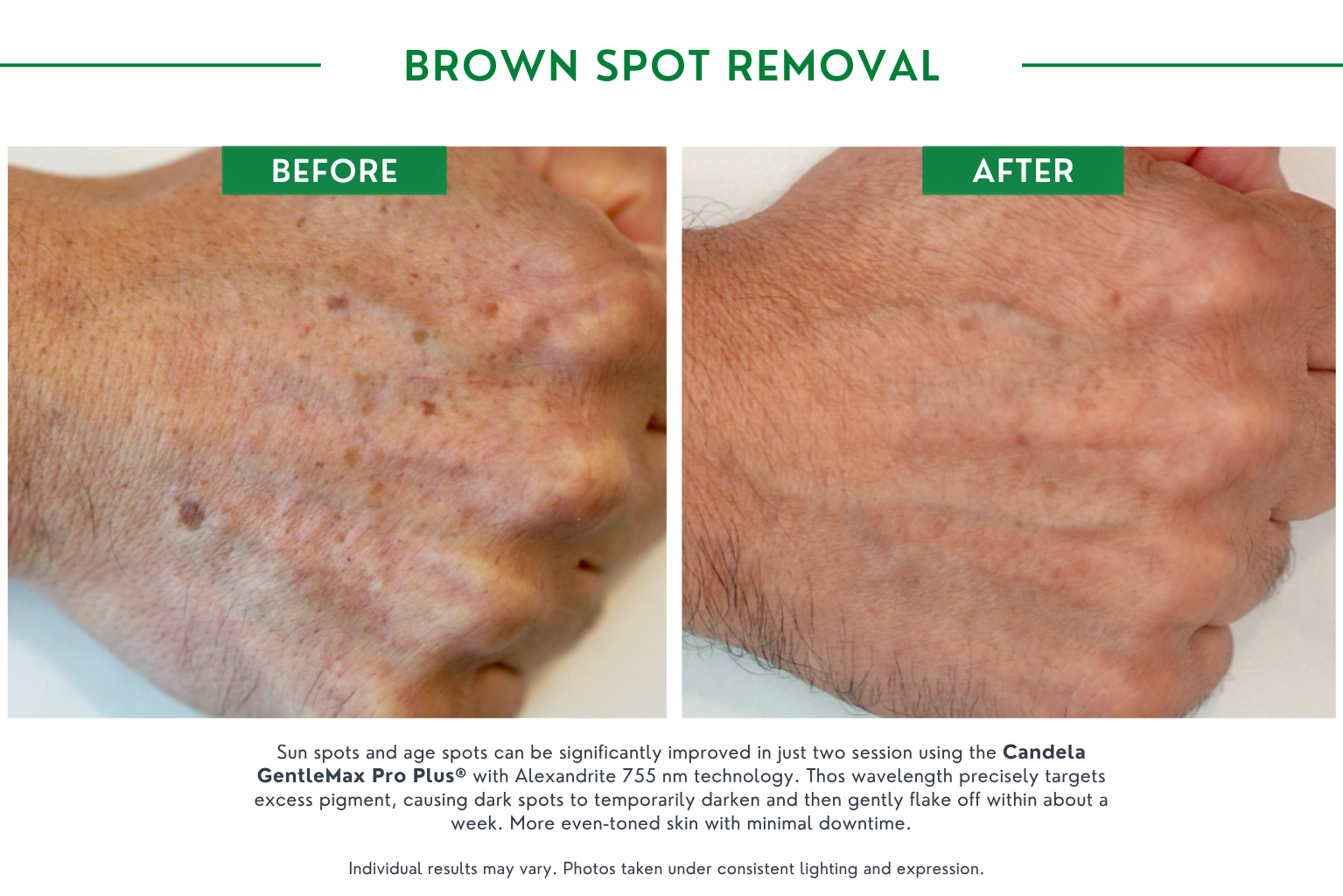 brown spot B_A (2)