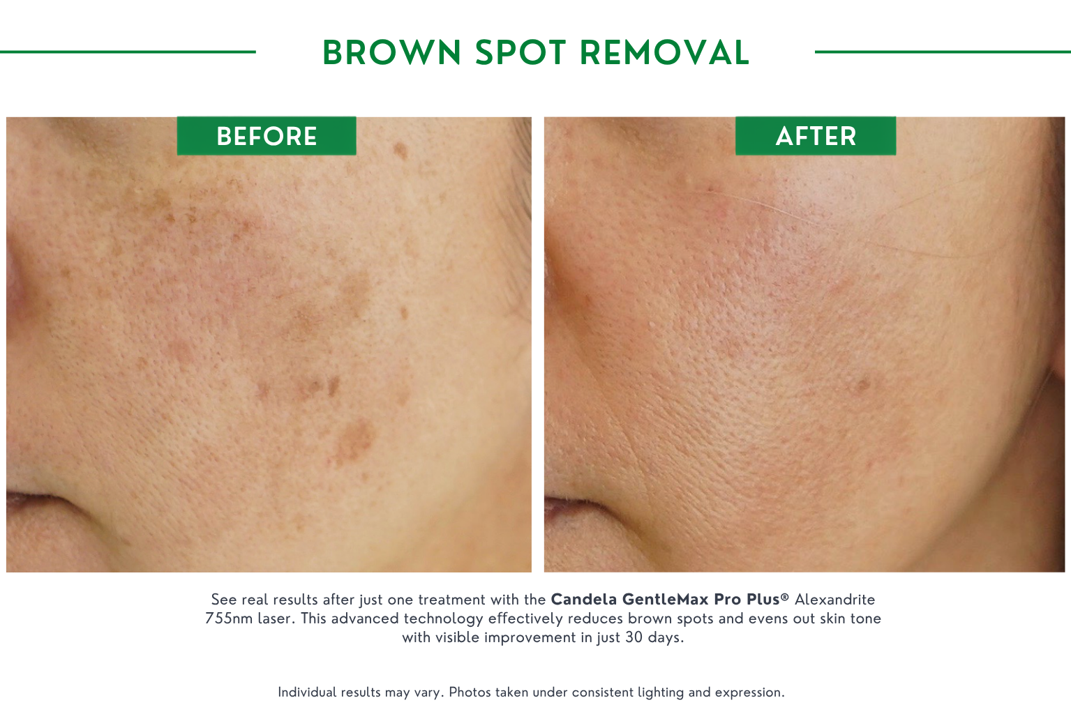 brown spot B_A (3)