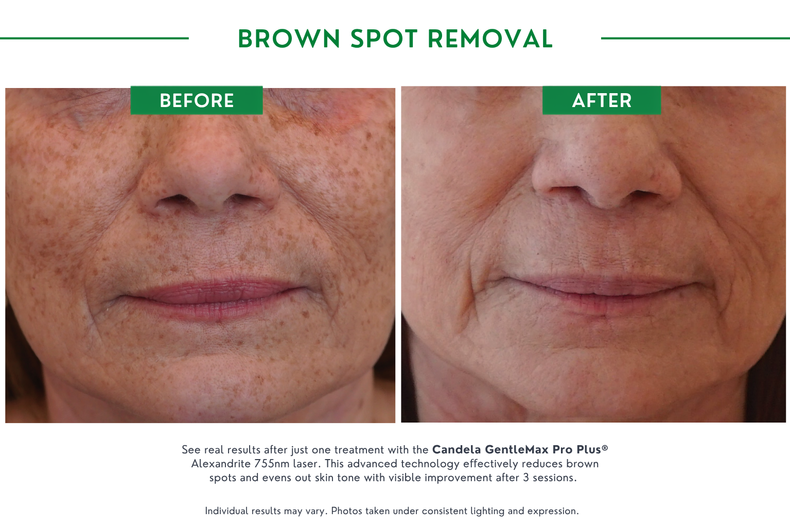 brown spot B_A (4)