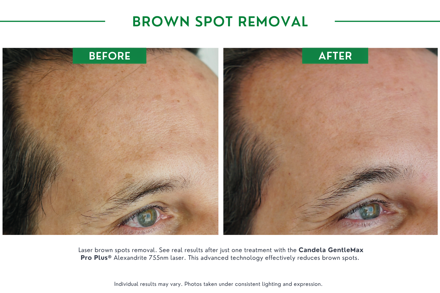 brown spot B_A (6)