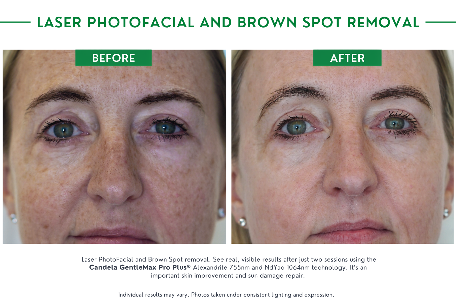 brown spot B_A (7)