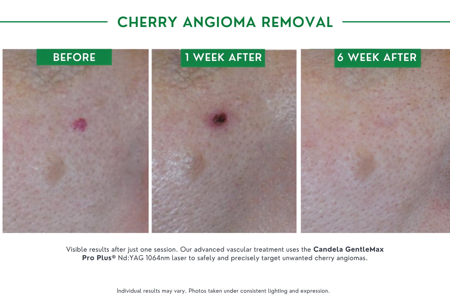cherry angioma B_a (1)