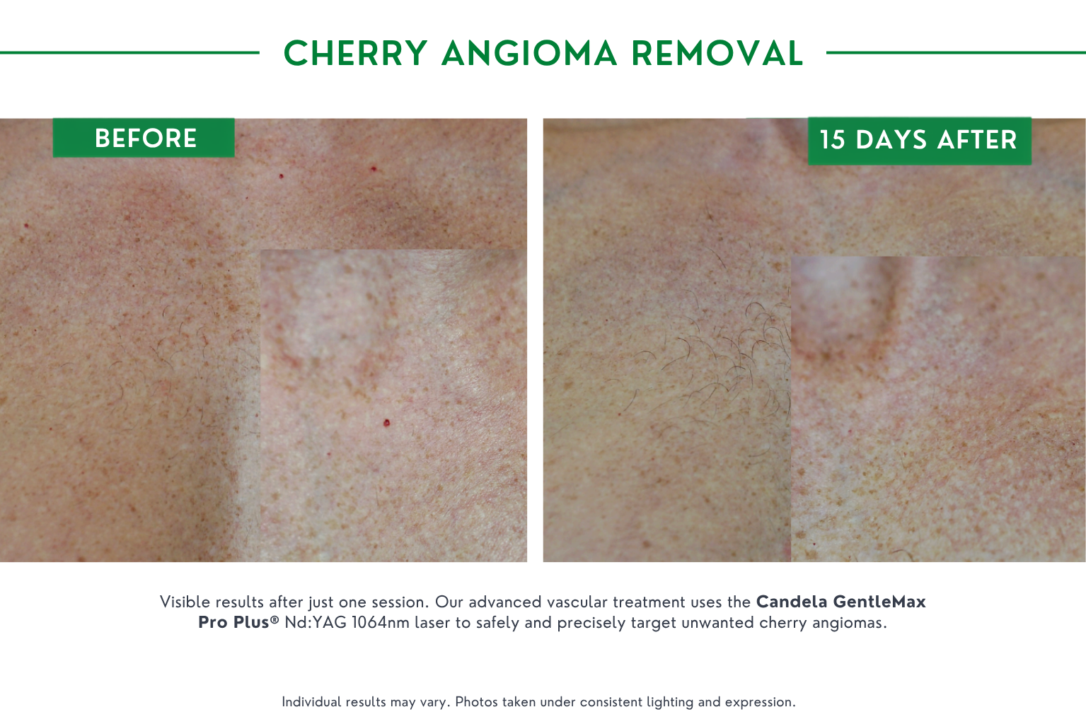 cherry angioma B_a (2)